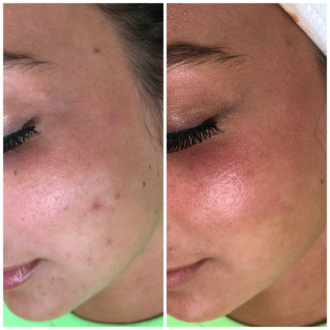 Microneedling